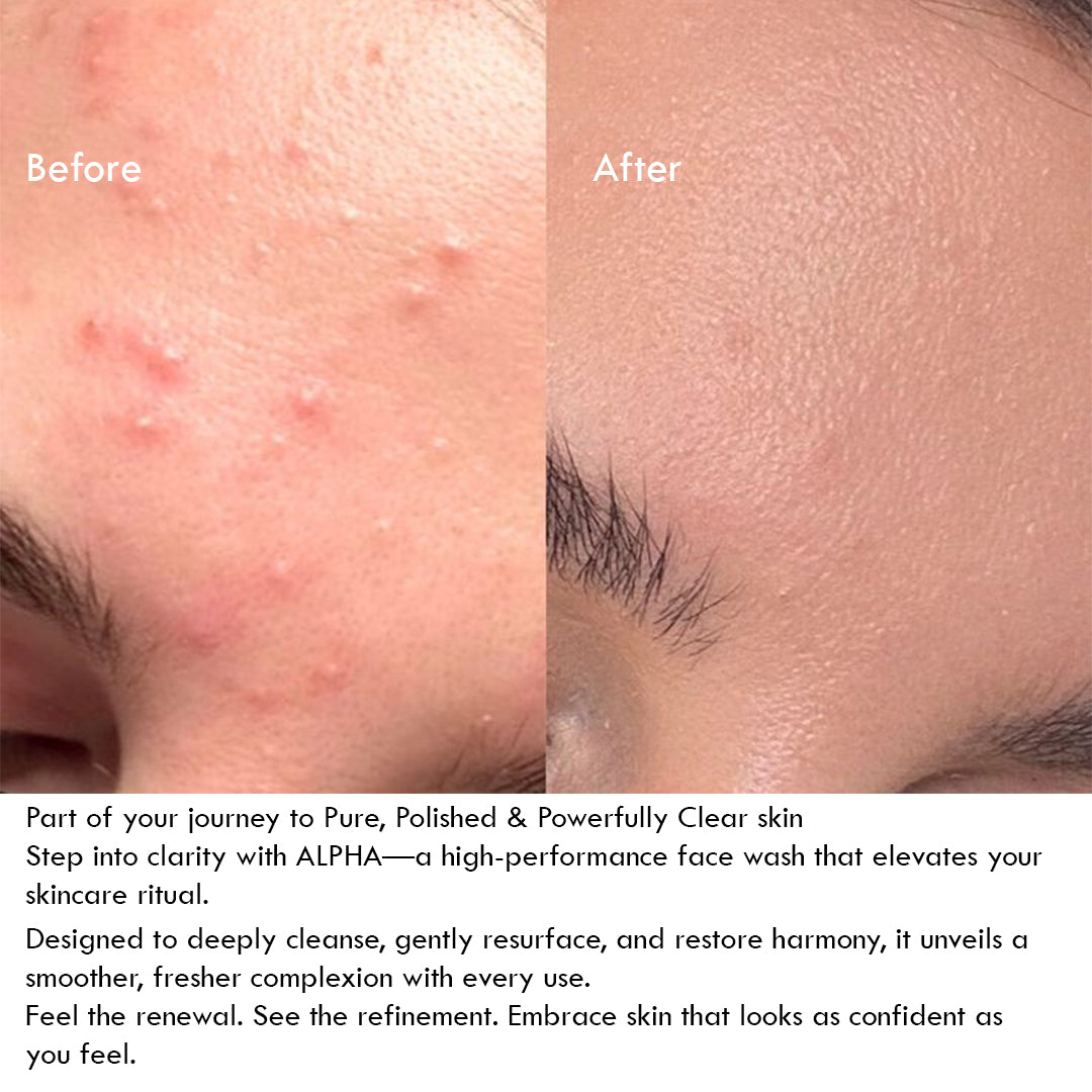AHA-5% Acne-Control Face Wash - ALPHA