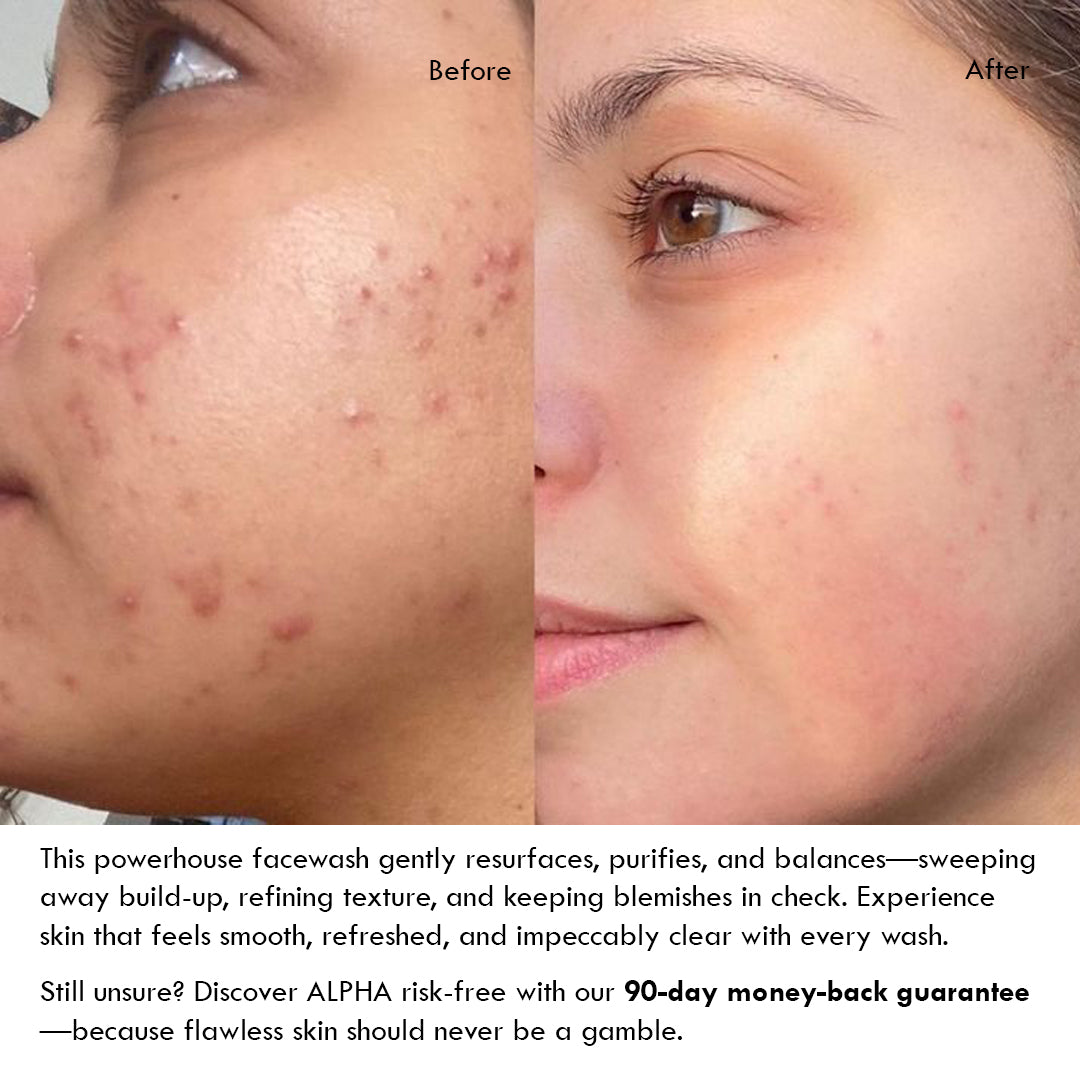 AHA-5% Acne-Control Face Wash - ALPHA