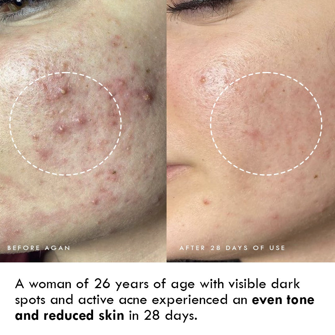 Anti-Blemish and Clarifying Brightening Gel Creme - HELLO HYDRATION