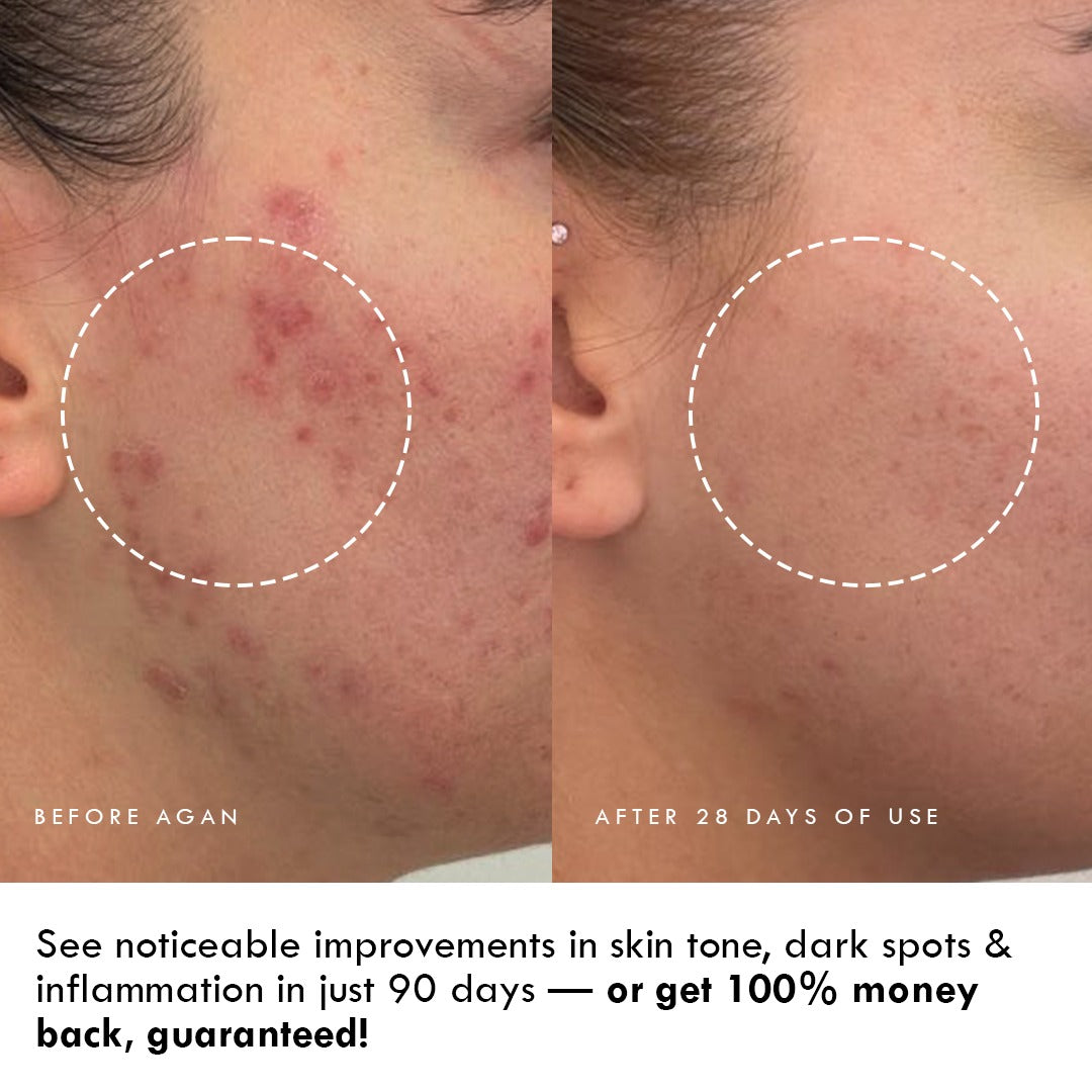 Anti-Blemish and Clarifying Brightening Gel Creme - HELLO HYDRATION